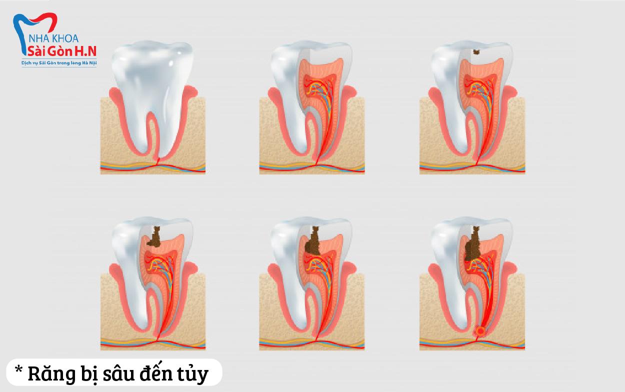 Sau khi điều trị xong nên bọc răng sứ