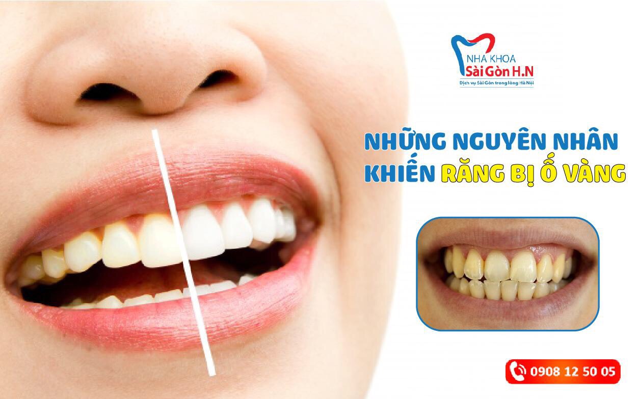 Răng bị ố vàng là do đâu